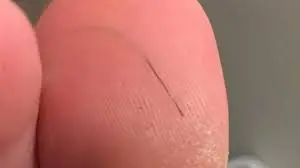 Hair Splinter: What It Is & How to Remove It Fast 4 Resident Workforce Update