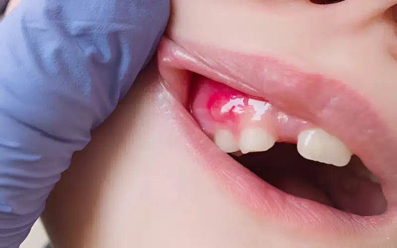 How Long Before a Tooth Infection Becomes Fatal? 2 How Long Before a Tooth Infection Becomes Fatal?.
